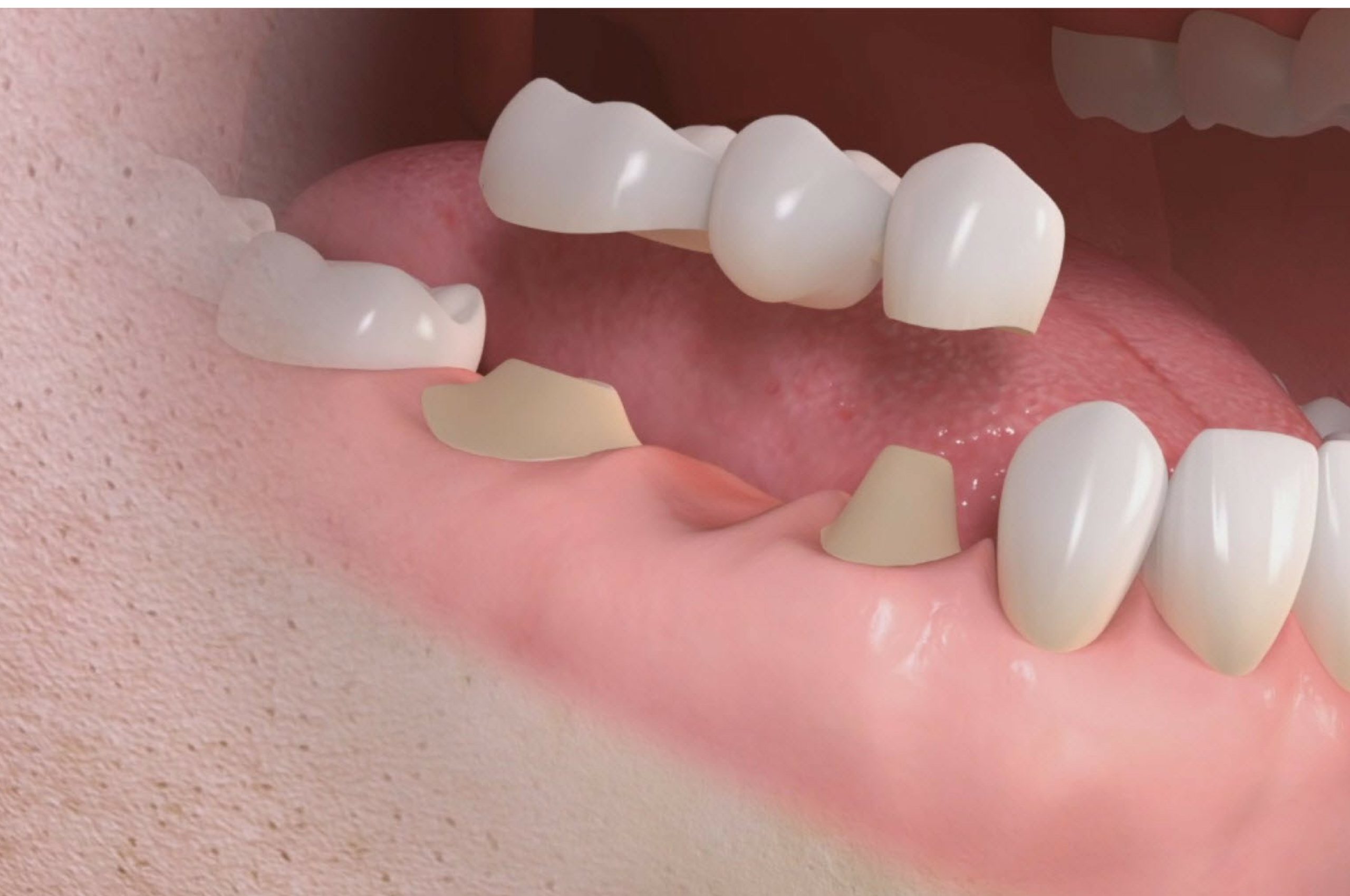 Puente de Ceramica sin metal