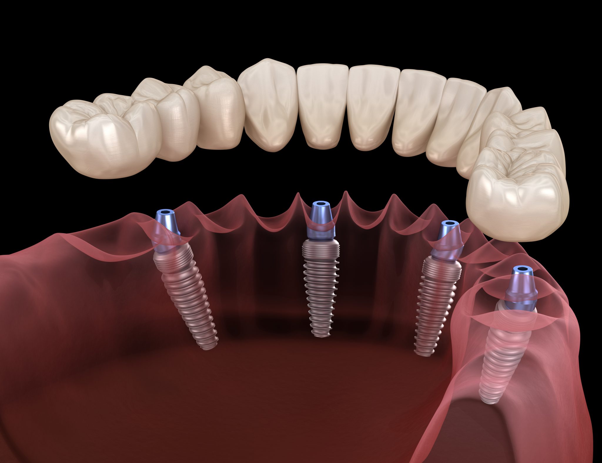 Puente sobre Implantes Dentales