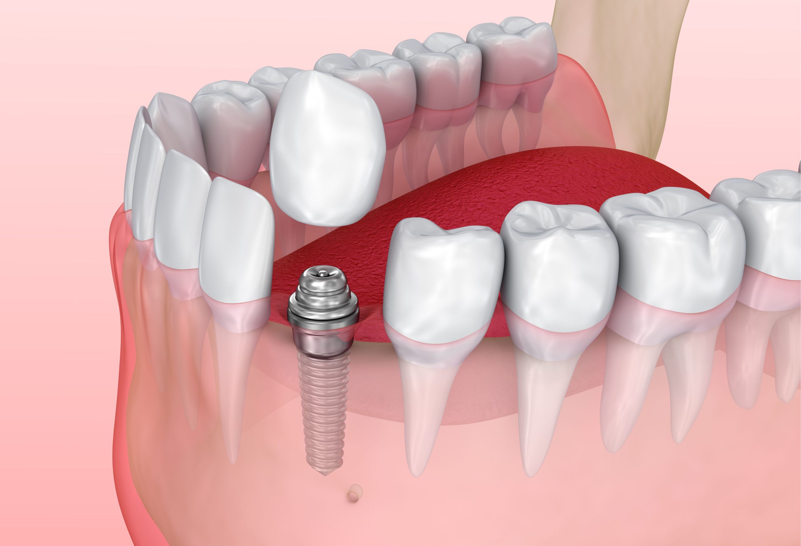Corona sobre Implante Dental